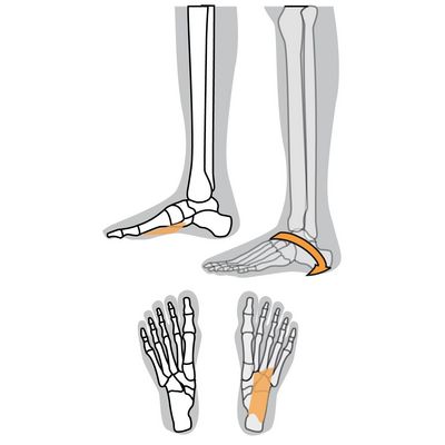 Quadratus Plantaris