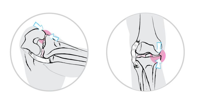When the knee joint is untowardly twisted to the side, the strain on the medial meniscus increases while the lateral collateral ligament is stretched (left). A lateral collateral ligament loosened in this way will lead to an unstable leg axis and increased strain on the medial meniscus also in a standing position (right).