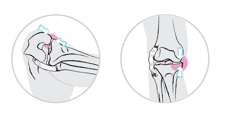 Image 2 When the knee joint is untowardly twisted to the side, the strain on the medial meniscus increases while the lateral collateral ligament is stretched (left). A lateral collateral ligament loosened in this way will lead to an unstable leg axis and increased strain on the medial meniscus also in a standing position (right).