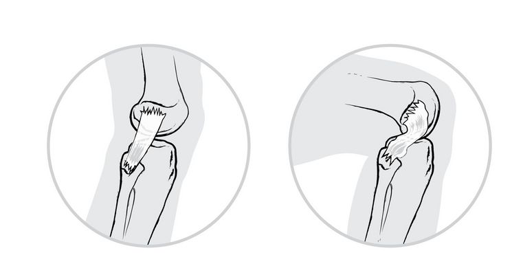 When the knee joint is extended, the collateral ligaments are tense (left), when the knee joint is flexed, the collateral ligaments are loose (right)