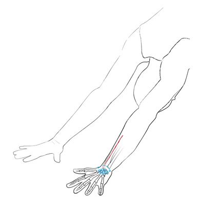 In positions in which the wrist is approximately in neutral position or, as is the case in the downward-facing dog (see image), in minimal extension, the edge of both the thumb and the little finger should be rooted into the mat with equal pressure.