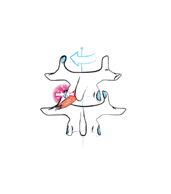 A malfunction and thus tensing up of one of the mm. rotatores brevi, longi or multifidi causes painful vertebral blockages.